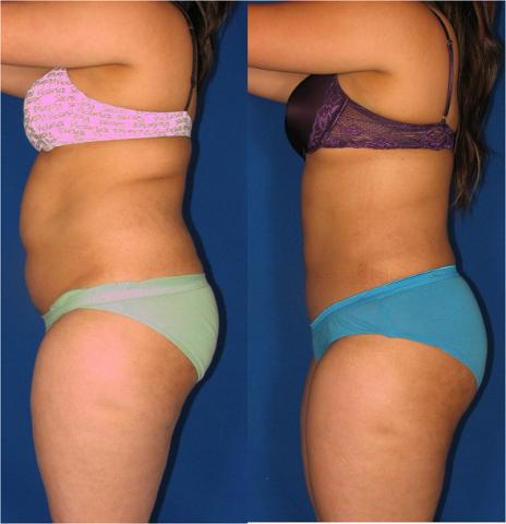 Laser Lipo, in Dallas TX