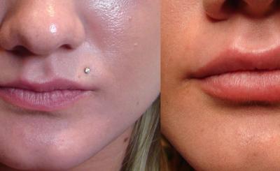 Juvederm, in Dallas TX