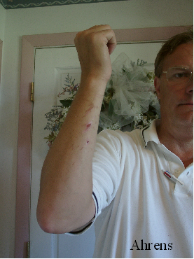 burned_arm_copy