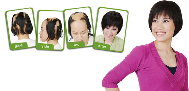 Hair Loss Treatment